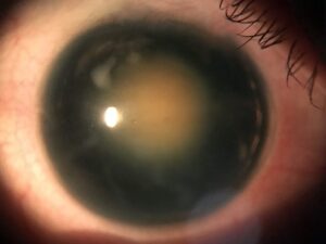 Eye with damage to iris. Before surgery.