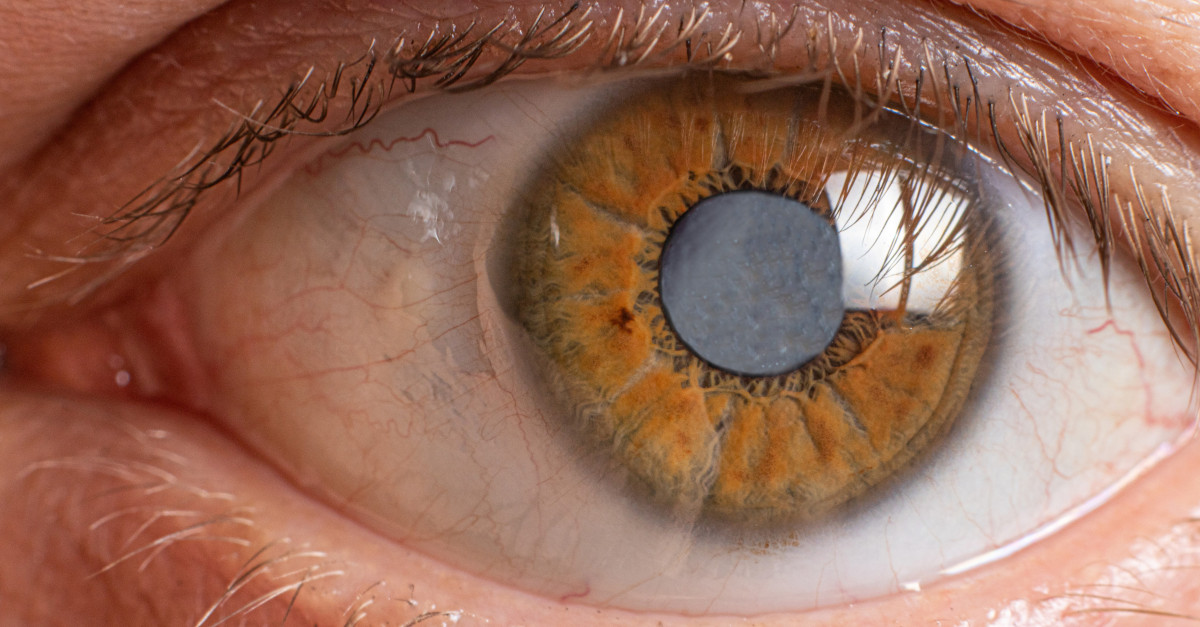 Cataracts 101: Symptoms, Diagnosis, and Treatment Options