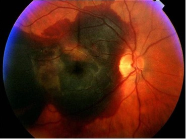 severe wet macular degeneration